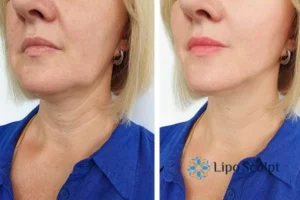 Double chin before and after Hi-Fu treatment 4 Book your double chin treatment Middlesex today! We are here to help!