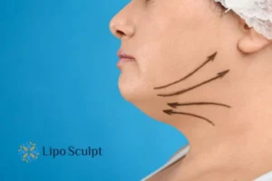 Double chin before and after Hi-Fu treatment 3 Boost your confidence with a Double chin treatment Middlesex