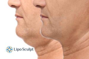 Double chin before and after Hi-Fu treatment 2 Double chin treatment Middlesex from Lipo Sculpt - feel more confident today!