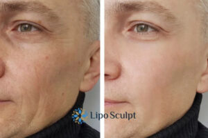 How to Fight Aging Symptoms 3 Fight Aging Symptoms Middlesex With HIFU and Morpheus8 Today!