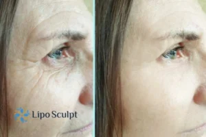 How to Fight Aging Symptoms 2 Do you want to Fight Aging Symptoms Middlesex? Contact Lipo Sculpt today!