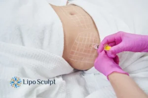 Are The Results From Aqualyx Permanent? 1 Do you want to know how long Aqualyx Middlesex results last?