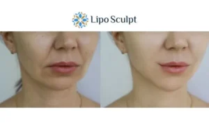Explaining Total Skin Tightening Treatment And What It Can Do For You 2 Do you want to boost your self confidence? Give Morpheus8 Middlesex a try today!