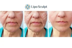 Explaining Total Skin Tightening Treatment And What It Can Do For You 3 Boost your confidence with Morpheus8 Middlesex call our team today!