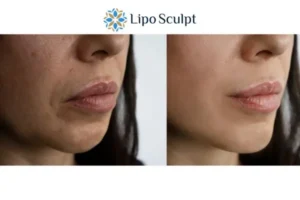 Explaining Total Skin Tightening Treatment And What It Can Do For You 4 Morpheus8 Middlesex the best results - call our team today!
