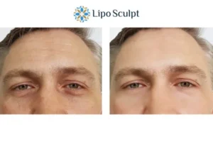 Explaining Total Skin Tightening Treatment And What It Can Do For You 6 Morpheus8 Middlesex book in today to find out more!