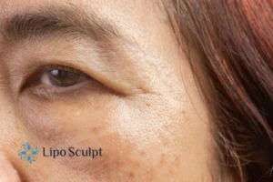 Cryopen: The Revolutionary Treatment for Age Spots Unveiled 2 Are age spots Middlesex giving you low self esteem? Contact us today!