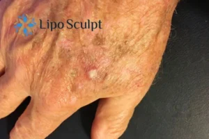 Best Actinic Keratoses Removal 2 Improve your wellbeing and health with Actinic Keratoses Middlesex removal.treatment