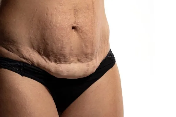 Lost the Weight but Not the Loose Skin? 1 image of womans stomach after weight loss showing loose skin Middlesex